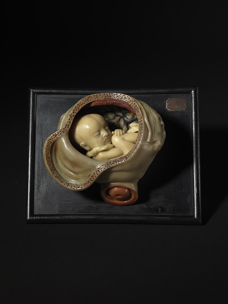 Utérus en état de gestation