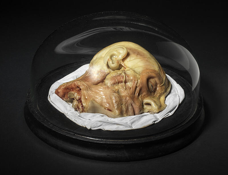 Nerf facial avec sa distribution et ses muscles