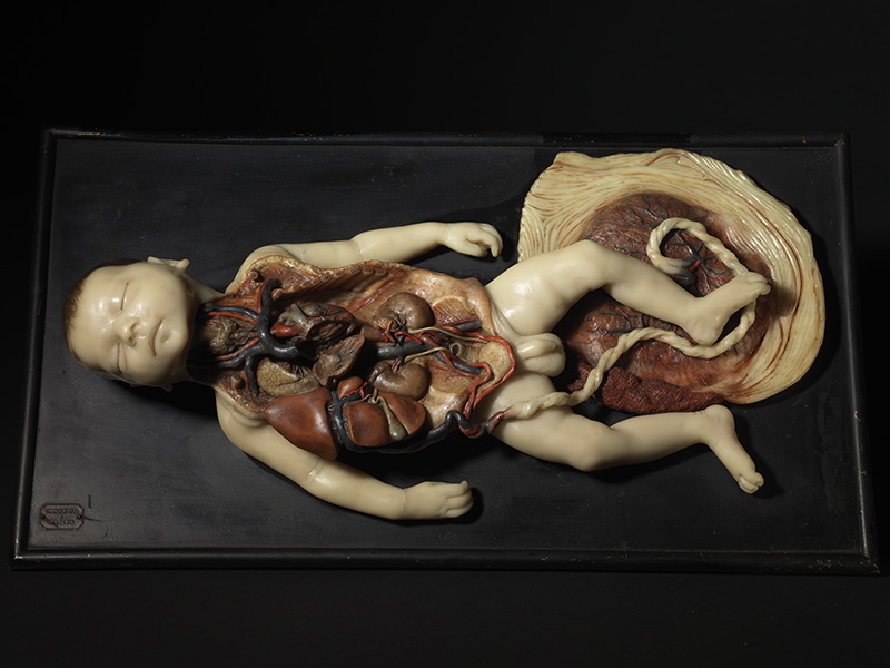 Foetus à terme